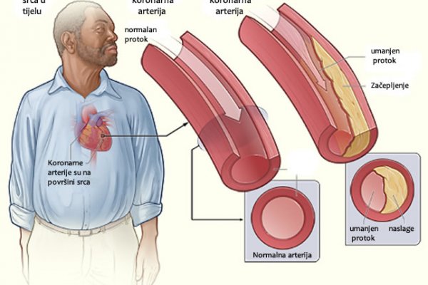 Sačuvajte srce, mozak i bubrege: OČISTITE ARTERIJE samo jednom čašom ovog snažnog pića!