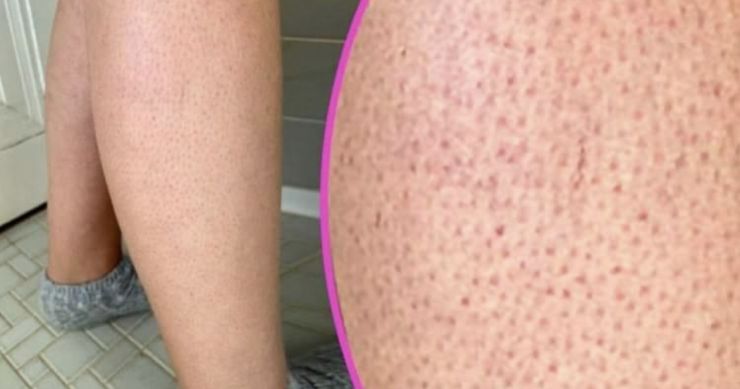 OVE TAČKICE NA NOGAMA VAM KVARE LJETO? Evo kako da ih se riješite, koža će vam biti glatka